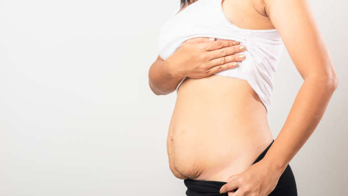 Bauch nach Schwangerschaft, ganz normal, Abnehmen nach der Schwangerschaft
